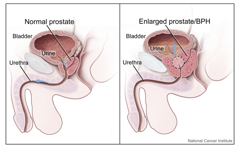 Prostate_(normal_and_enlarged)