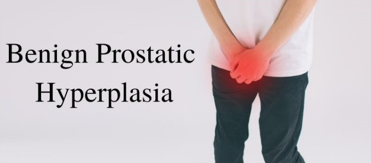 Benign Prostatic Hyperplasia BPH