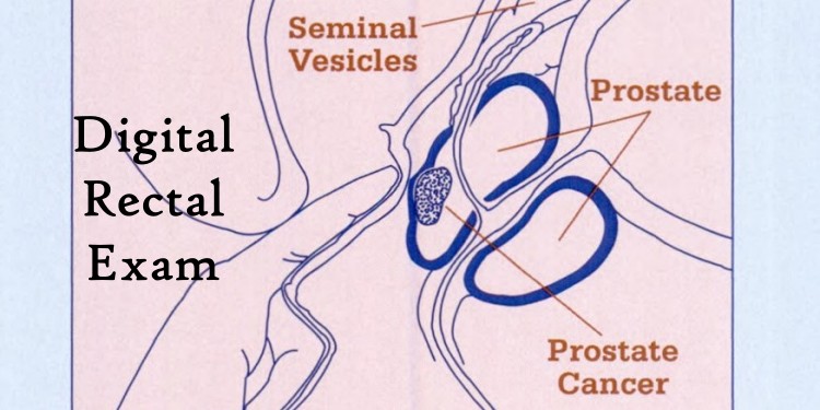 Digital Rectal Exam Diagram