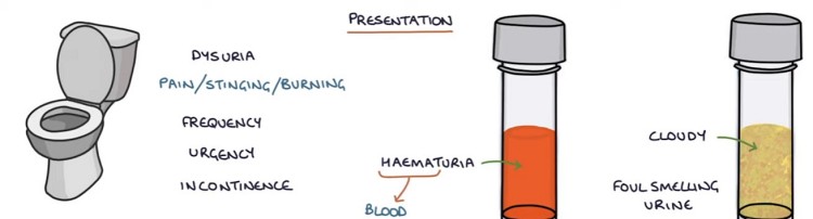 Lower Urinary Tract Symptoms LUTS