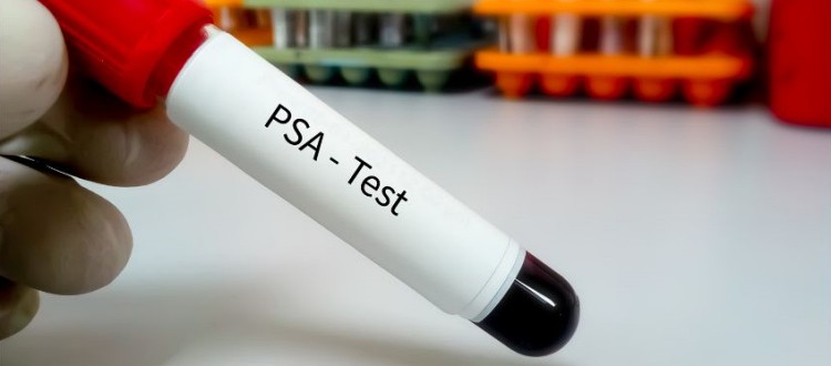 PSA test Prostate Specific Antigen