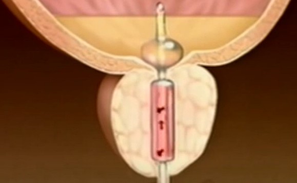 REZUM Thermotherapy