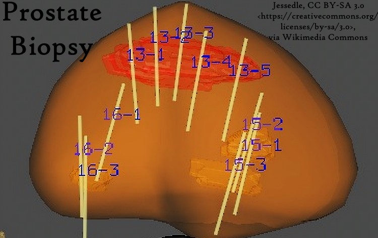 Targeted_MRI-US_fusion_prostate_biopsy_at_UCLA