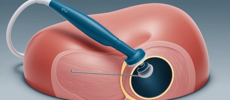 Transrectal ultrasound TRUS