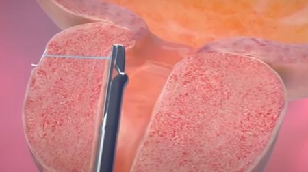 UroLift System