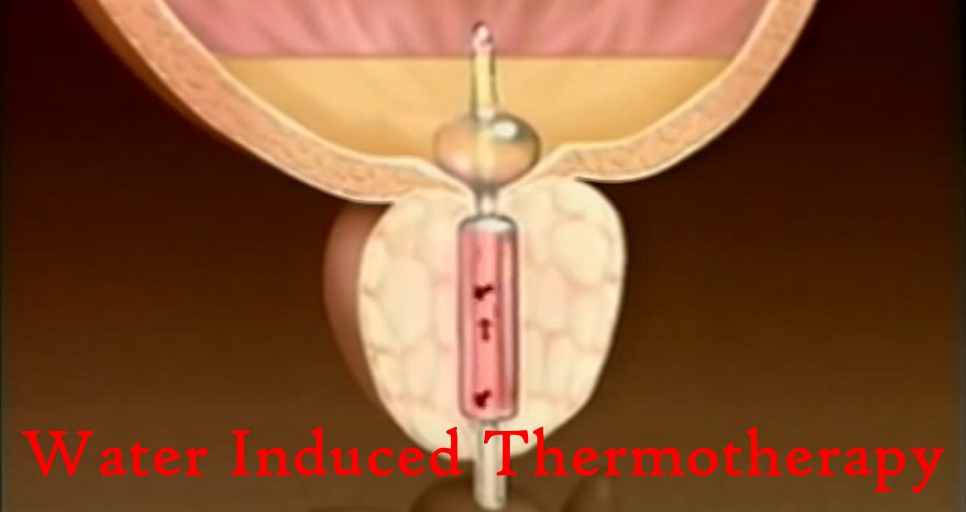 WIT Treatment for Prostate
