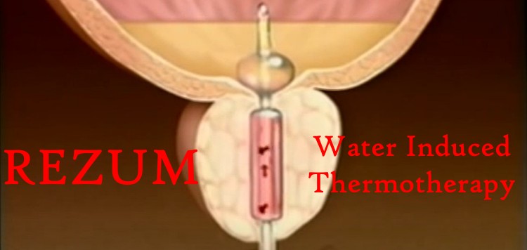 WIT procedure for Prostate REZUM